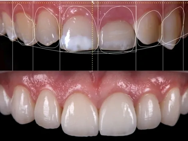 Smile designing in Bangalore