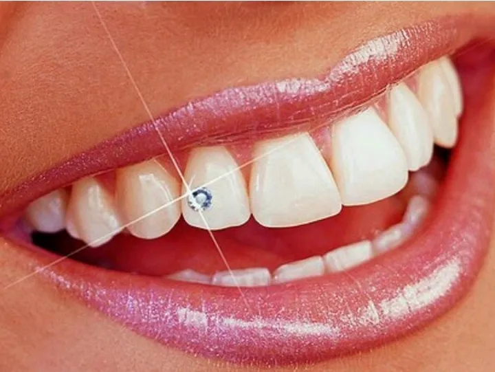 Tooth jewellery
