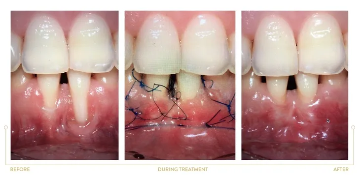 Flap procedure periodontal surgery