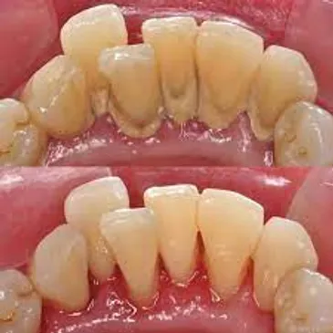 Teeth scaling