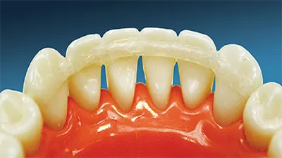 Dental splinting