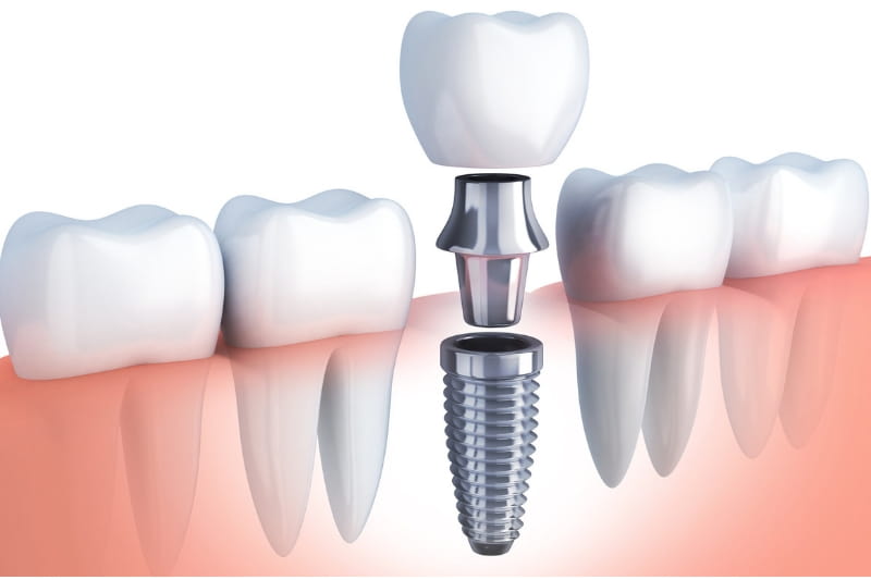 Dental implants 