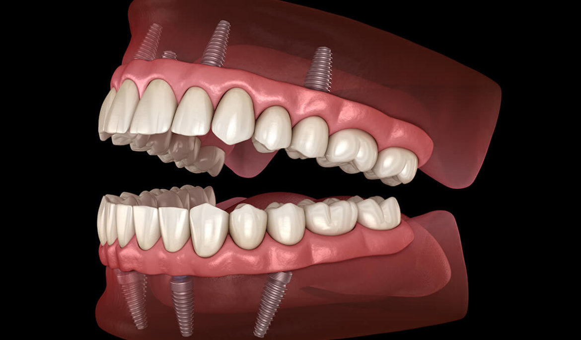 full mouth rehabilitation