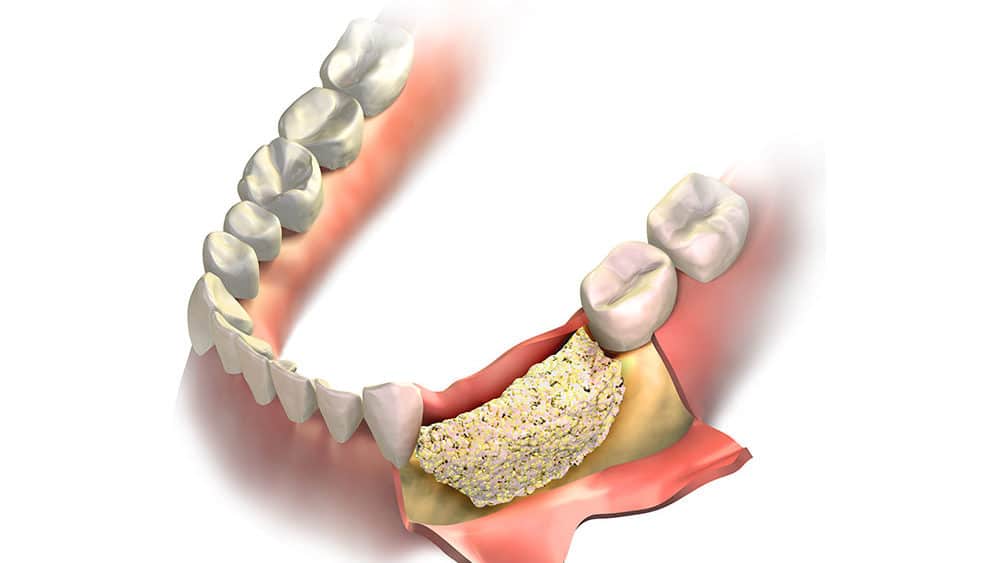 Bone Graft