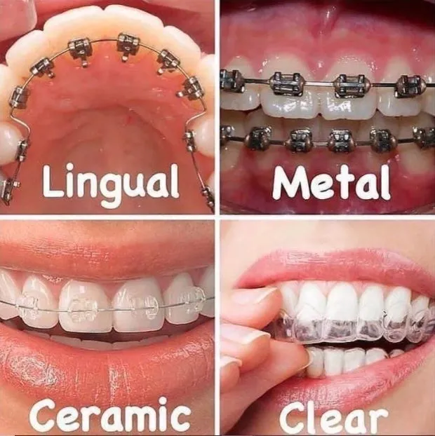 Dental Braces