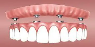 Overdenture