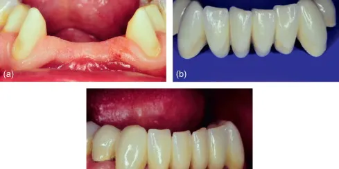 fixed partial dentures