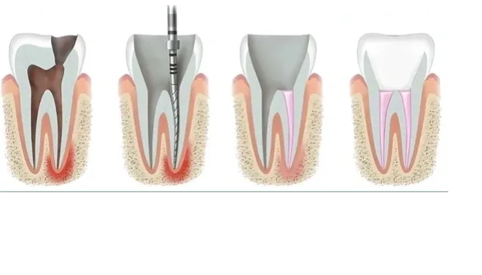 root canal treatment